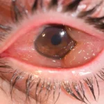Chemosis