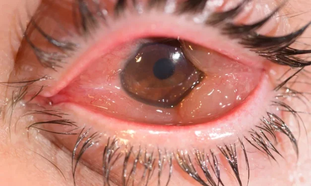 Chemosis: A Sign With a Wide Differential