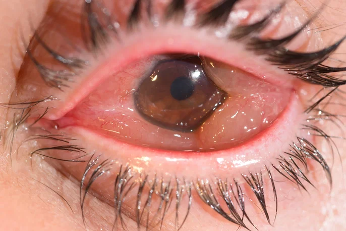 Chemosis: A Sign With a Wide Differential