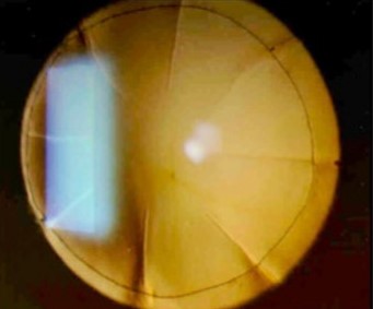 Radial keratotomy: slit-lamp photograph showing radial incisions extending close to the visual axis