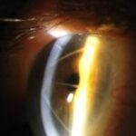 Radial keratotomy: slit-lamp photograph showing radial corneal incisions and peripheral corneal bulging
