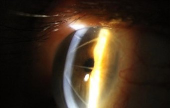 Radial Keratotomy: A Retired Surgery That Still Complicates Cataract Care