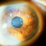 Clinical eye photograph illustrating Recurrent Corneal Erosion Syndrome Treatment