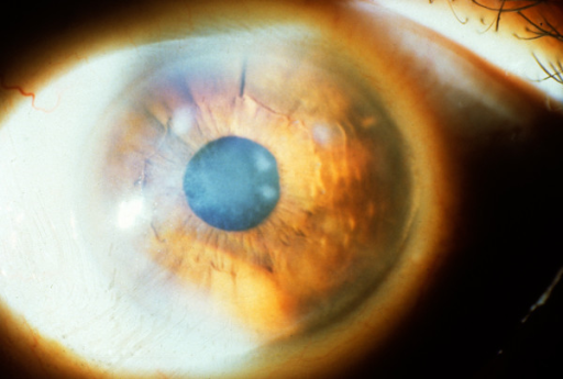 Recurrent Corneal Erosion Syndrome: Breaking the Cycle of Nighttime Pain