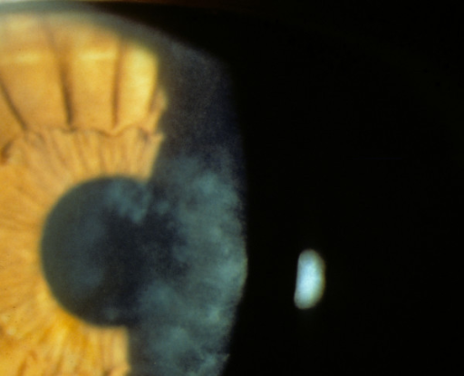 Clinical eye photograph illustrating Recurrent Corneal Erosion Syndrome Treatment