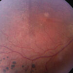 Refsum Disease: clinical photograph