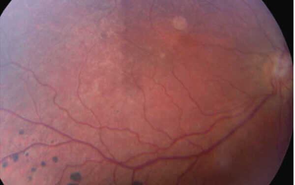 Refsum Disease: The Retinitis Pigmentosa You Can Treat With Diet