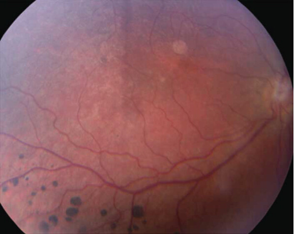 Refsum Disease Clinical Photograph 1 Refsum Disease: clinical photograph