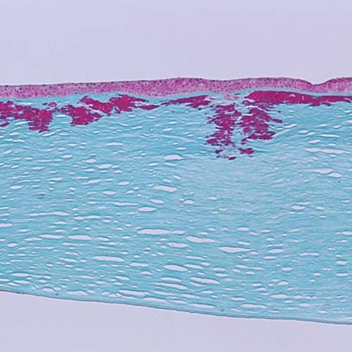 Reis-Bucklers corneal dystrophy: histology showing deposits in the superficial cornea at the Bowman layer