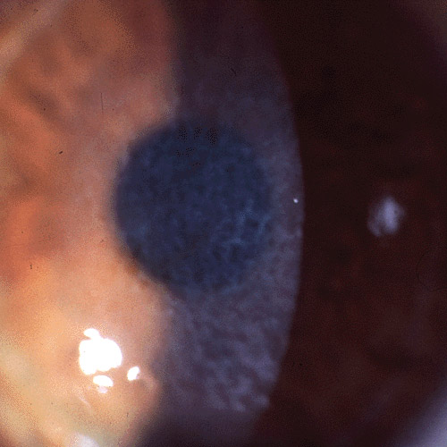 Reis-Bucklers Corneal Dystrophy: Bowman’s Layer Under Attack
