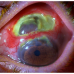Clinical eye photograph illustrating Relapsing Polychondritis Ocular Involvement
