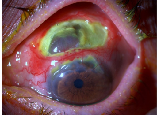 Relapsing Polychondritis and the Eye: When Cartilage Inflammation Threatens Vision