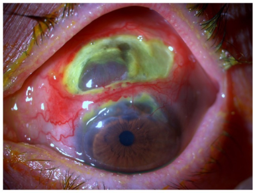 Relapsing Polychondritis and the Eye: When Cartilage Inflammation Threatens Vision