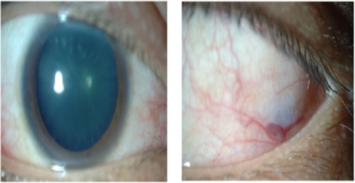 Clinical eye photograph illustrating Relapsing Polychondritis Ocular Involvement