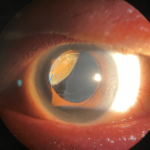 Retained Lens Fragments Dropped Nucleus: clinical photograph