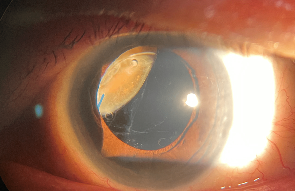 Retained Lens Fragments: When the Nucleus Drops Into the Vitreous