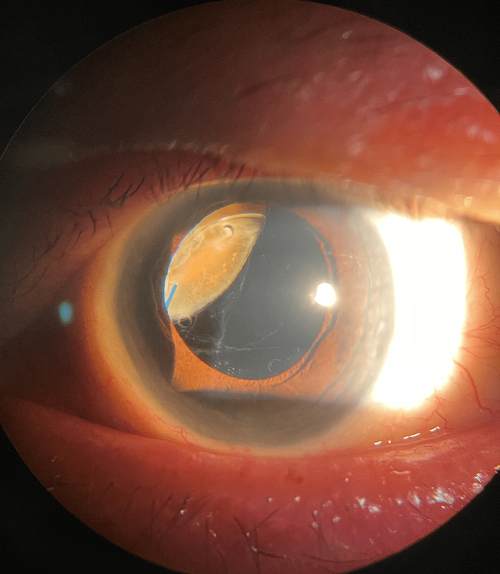 Retained Lens Fragments Dropped Nucleus Clinical Photograph 1 Retained Lens Fragments Dropped Nucleus: clinical photograph