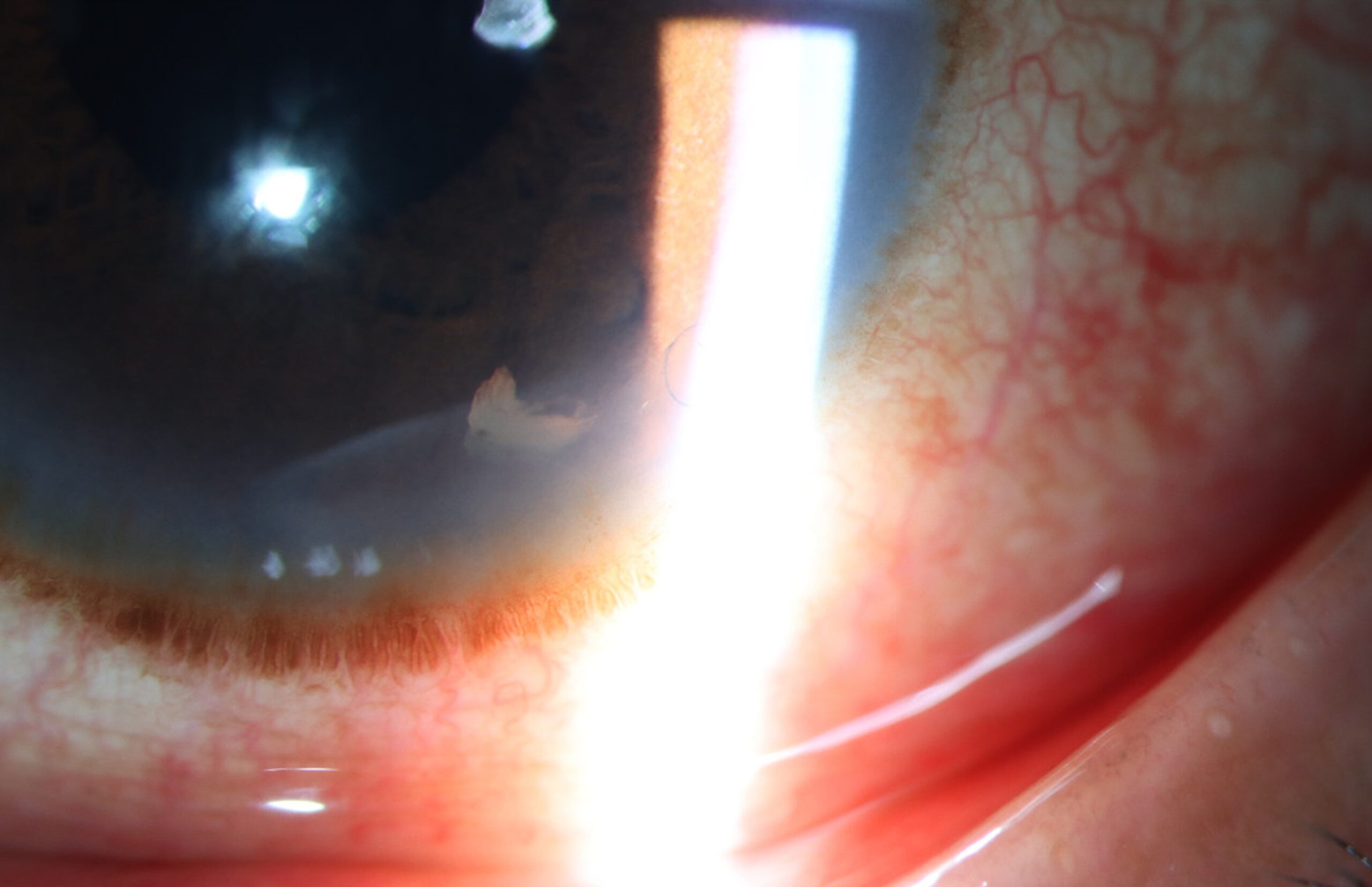 Retained Lens Fragments Dropped Nucleus Clinical Photograph 2 Retained Lens Fragments Dropped Nucleus: clinical photograph, second view
