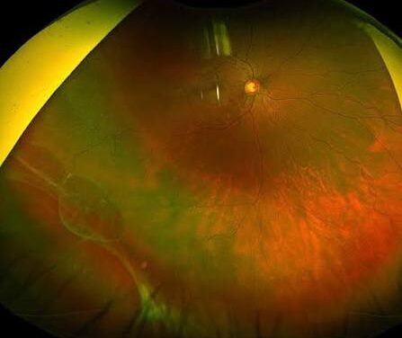 Retinal Dialysis: The Slow-Motion Detachment at the Ora Serrata