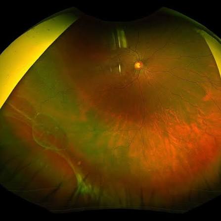 Retinal Dialysis Clinical Photograph 1 Retinal Dialysis: clinical photograph