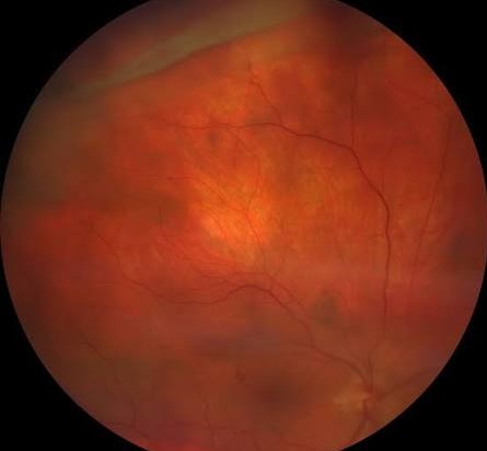 Retinal Dialysis Clinical Photograph 2 Retinal Dialysis: clinical photograph, second view