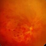 Retinal hemorrhage: fundus photograph showing scattered intraretinal hemorrhages in the posterior pole