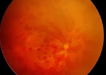 Retinal Hemorrhage Patterns: What the Layer, Shape and Color Tell You