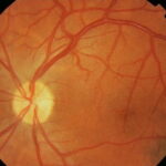 Retinal Macrovessel: clinical photograph