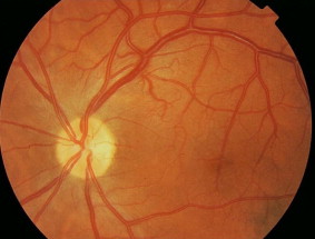 Retinal Macrovessel: The Dramatic-Looking Vessel That Usually Means Nothing