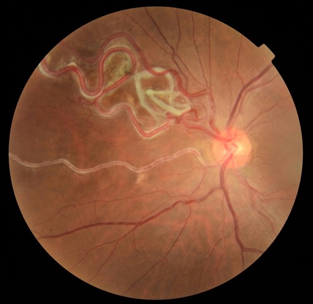 Retinal Macrovessel Clinical Photograph 2 Retinal Macrovessel: clinical photograph, second view