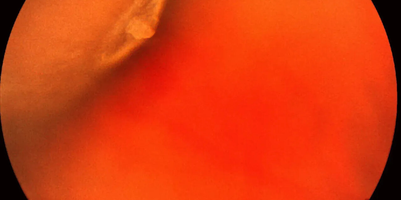 Retinal Tufts: Small Peripheral Findings With an Outsized Reputation