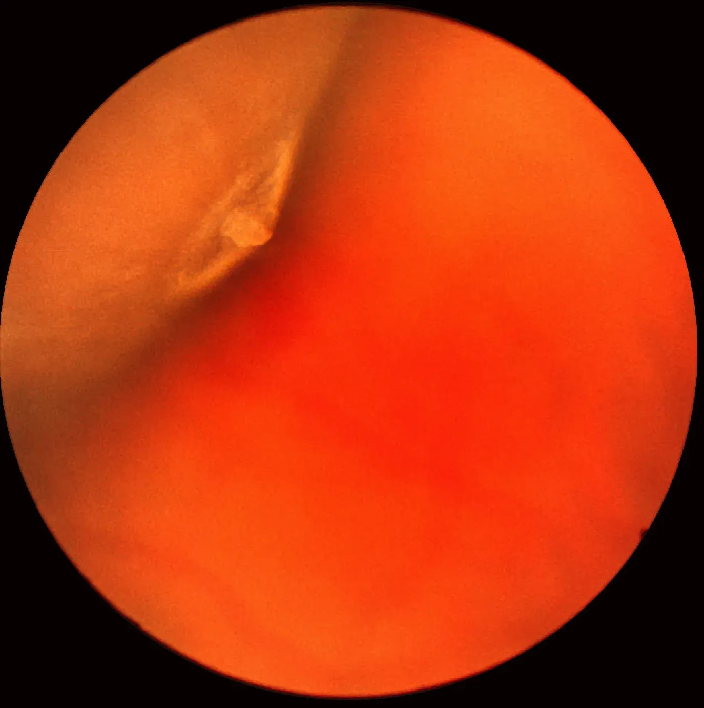 Clinical eye photograph illustrating Retinal Tuft Detachment Risk