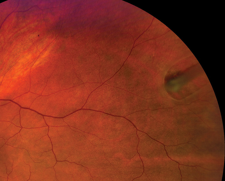 Clinical eye photograph illustrating Retinal Tuft Detachment Risk