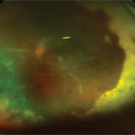 Retinal Vasculitis Diagnostic Approach: clinical photograph