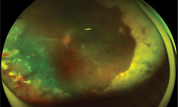 Retinal Vasculitis: A Diagnostic Approach by Pattern and Cause