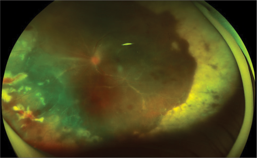 Retinal Vasculitis Diagnostic Approach Clinical Photograph 1 Retinal Vasculitis Diagnostic Approach: clinical photograph