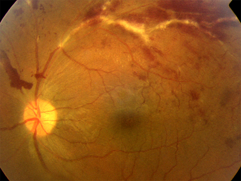 Retinal Vasculitis Diagnostic Approach Clinical Photograph 2 Retinal Vasculitis Diagnostic Approach: clinical photograph, second view