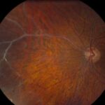 Clinical eye photograph illustrating Retinal Vasculitis Sheathing Patterns