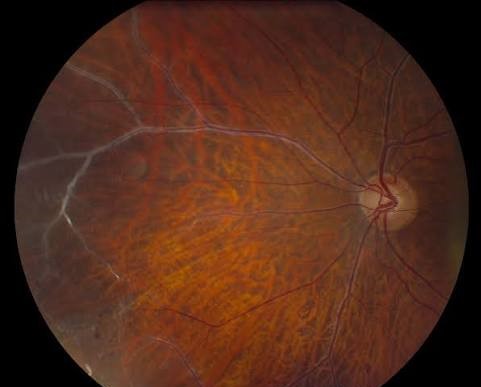 Retinal Vasculitis Sheathing Patterns: The Vascular Clues to a Systemic Diagnosis