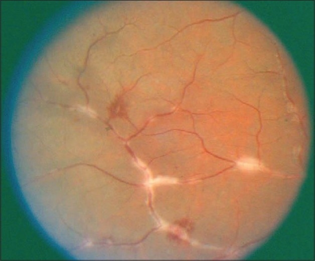 Clinical eye photograph illustrating Retinal Vasculitis Sheathing Patterns