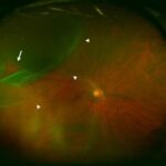 Rhegmatogenous retinal detachment: ultra-widefield fundus image showing a superior retinal detachment with a retinal break (arrow)