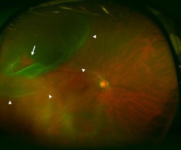 Rhegmatogenous Retinal Detachment Ultra-Widefield Rhegmatogenous retinal detachment: ultra-widefield fundus image showing a superior retinal detachment with a retinal break (arrow)