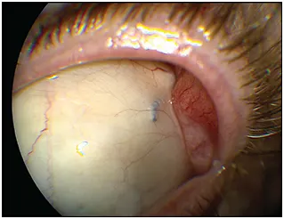 Scleral Buckle Surgery