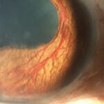 Rubeosis iridis: slit-lamp photograph showing new vessels on the iris surface