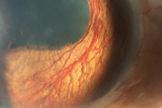 Rubeosis Iridis: Catching Neovascular Glaucoma Before the Angle Closes