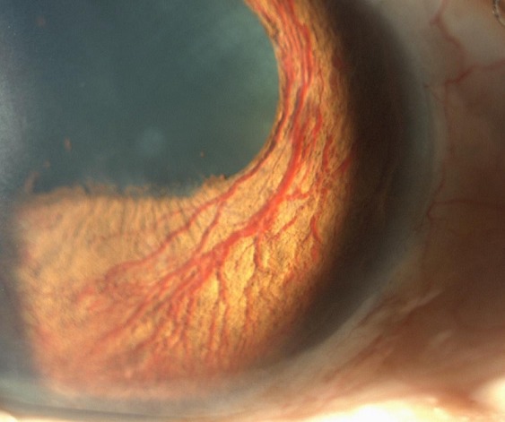 Rubeosis Iridis: Catching Neovascular Glaucoma Before the Angle Closes