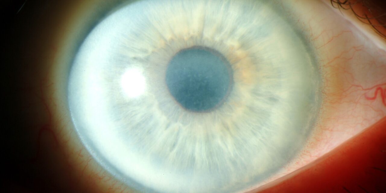 Schnyder Corneal Dystrophy: A Corneal Clue to Systemic Lipid Disease