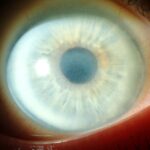 Schnyder Corneal Dystrophy: clinical photograph