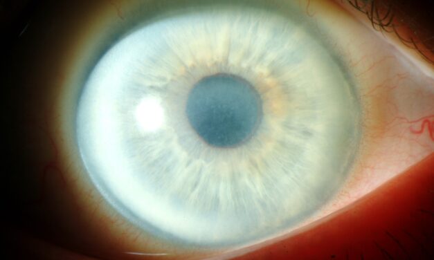 Schnyder Corneal Dystrophy: A Corneal Clue to Systemic Lipid Disease