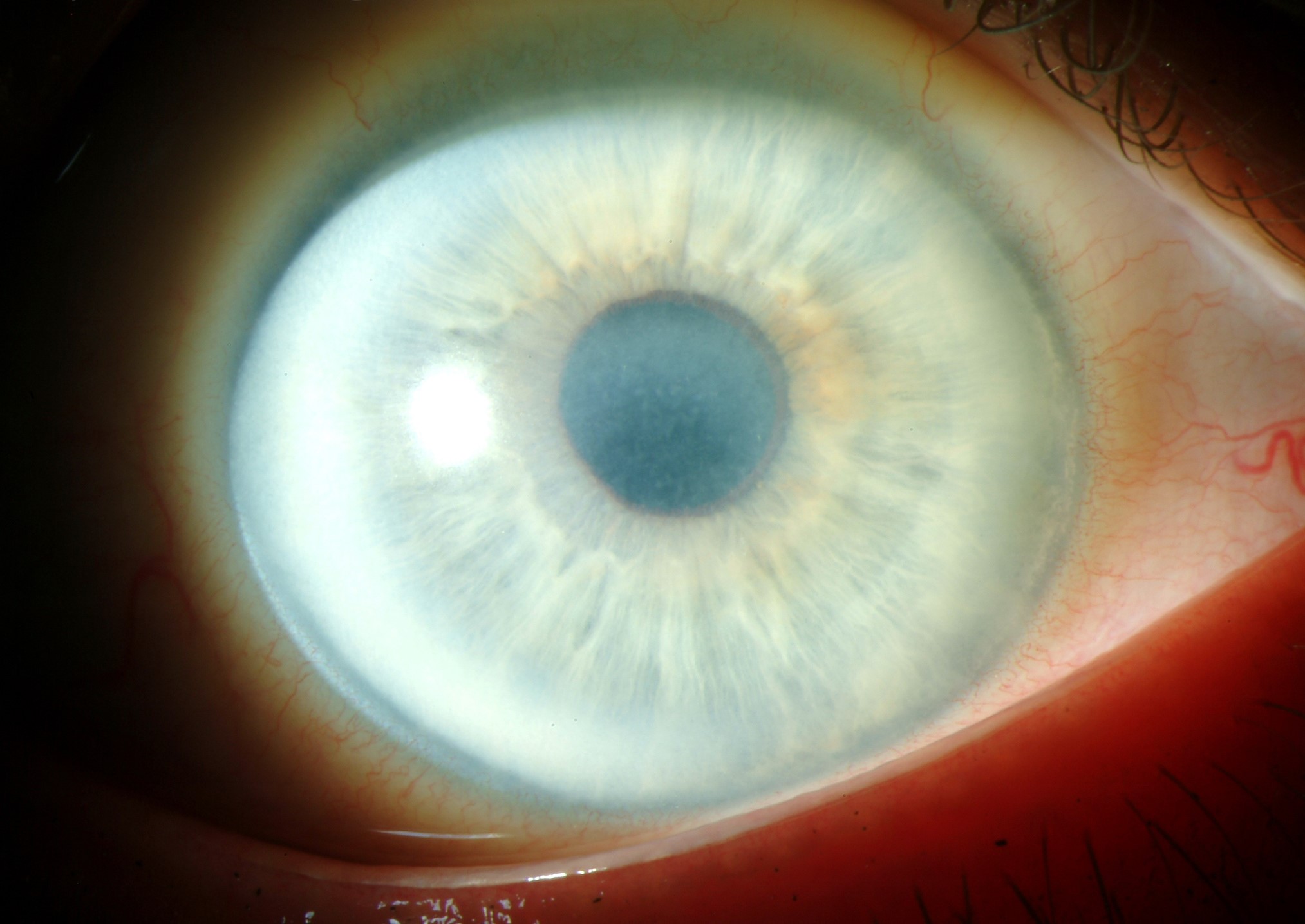 Schnyder Corneal Dystrophy Clinical Photograph 1 Schnyder Corneal Dystrophy: clinical photograph